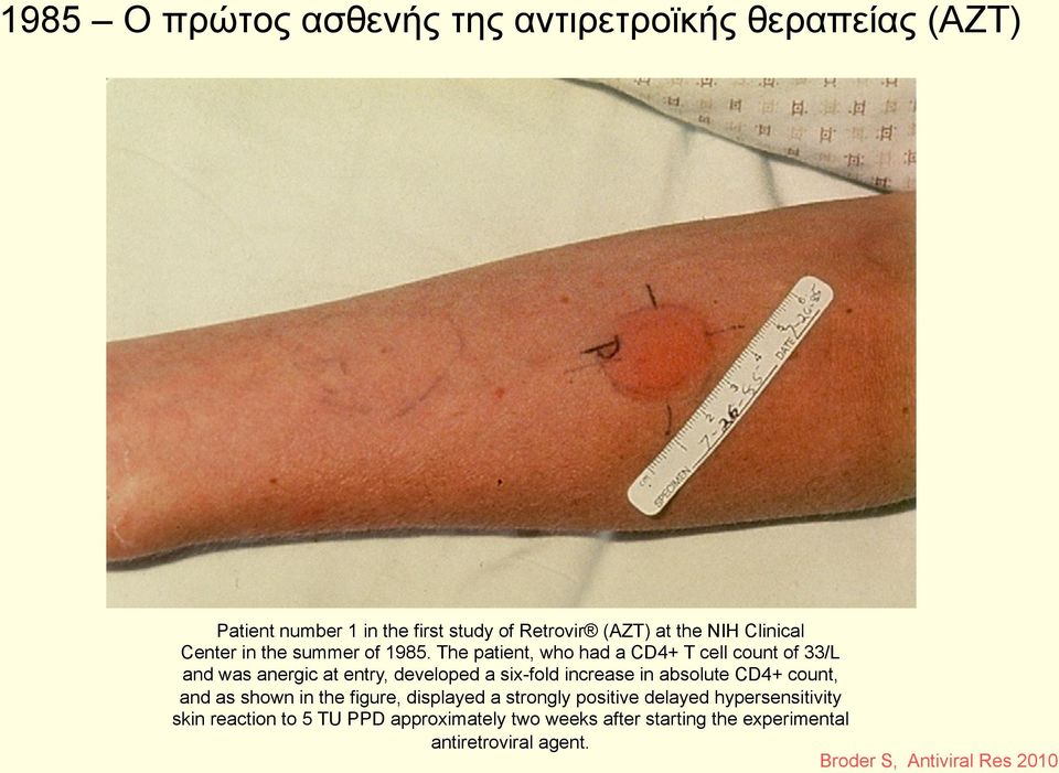 The patient, who had a CD4+ T cell count of 33/L and was anergic at entry, developed a six-fold increase in absolute CD4+