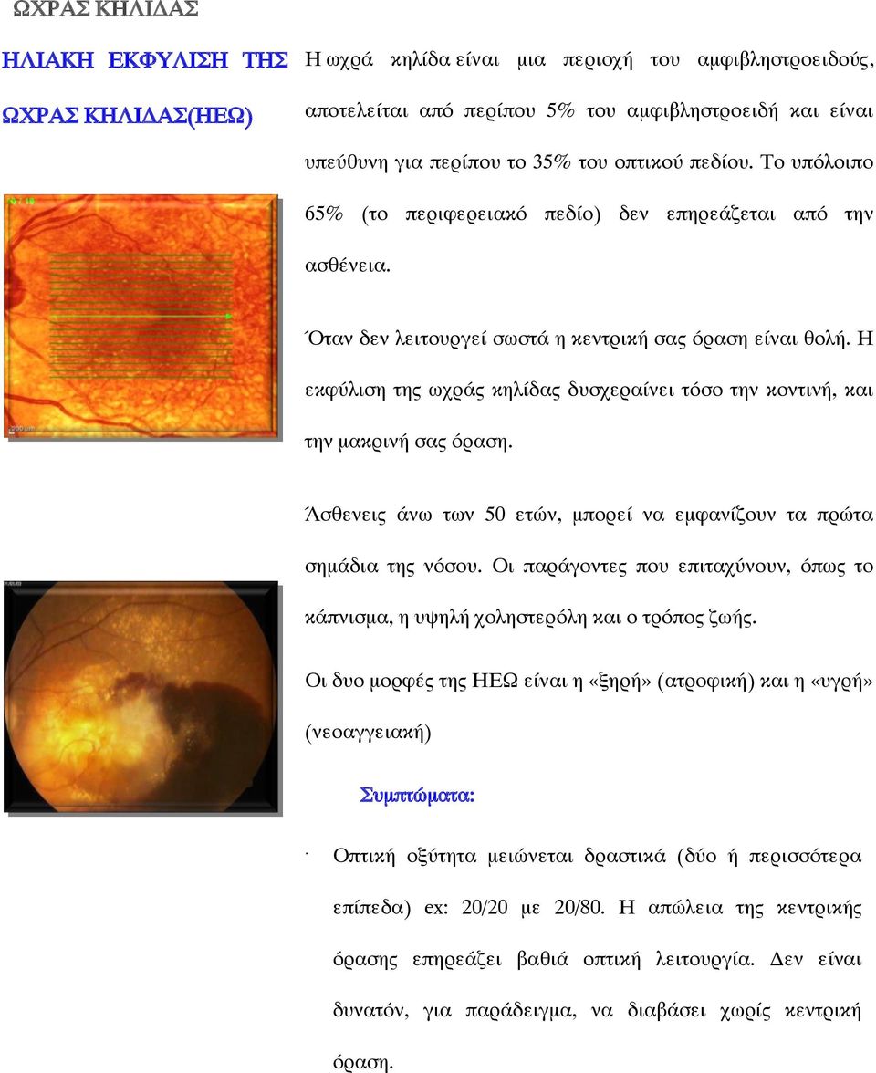 Η εκφύλιση της ωχράς κηλίδας δυσχεραίνει τόσο την κοντινή, και την μακρινή σας όραση. Άσθενεις άνω των 50 ετών, μπορεί να εμφανίζουν τα πρώτα σημάδια της νόσου.