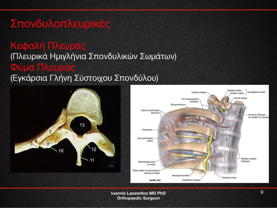 Σπονδυλικών Σωμάτων) Φύμα