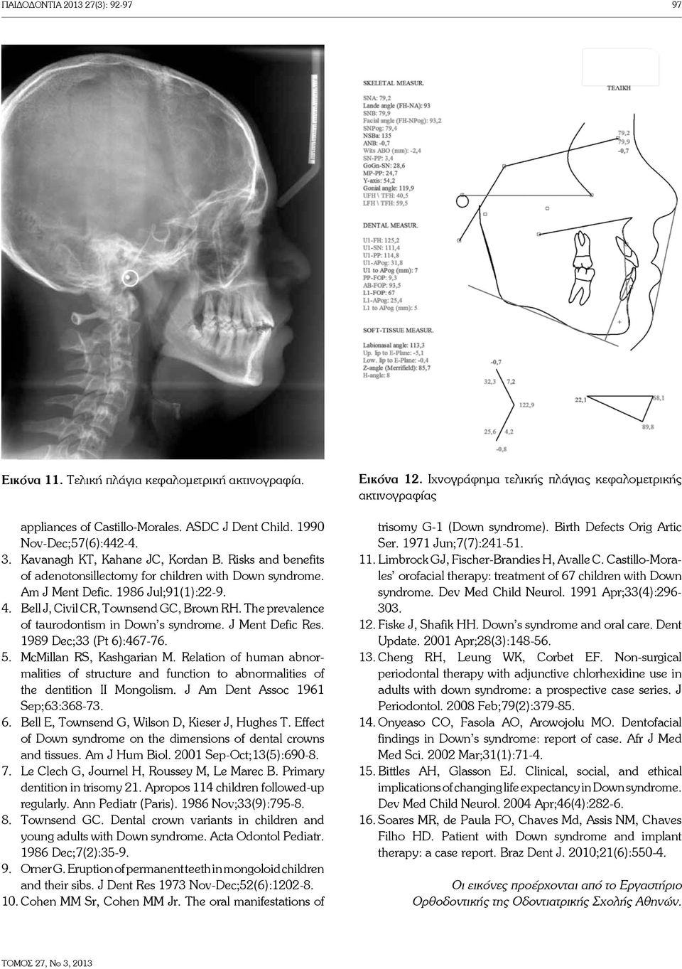 The prevalence of taurodontism in Down s syndrome. J Ment Defic Res. 1989 Dec;33 (Pt 6):467-76. 5. McMillan RS, Kashgarian M.