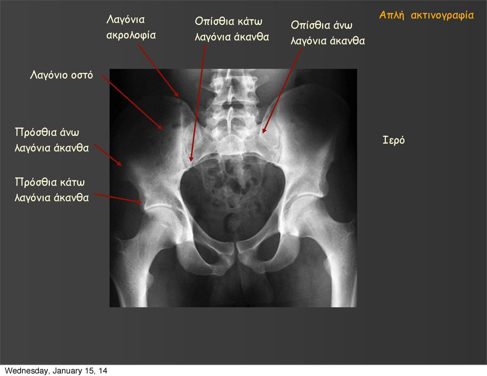 ακτινογραφία Λαγόνιο οστό