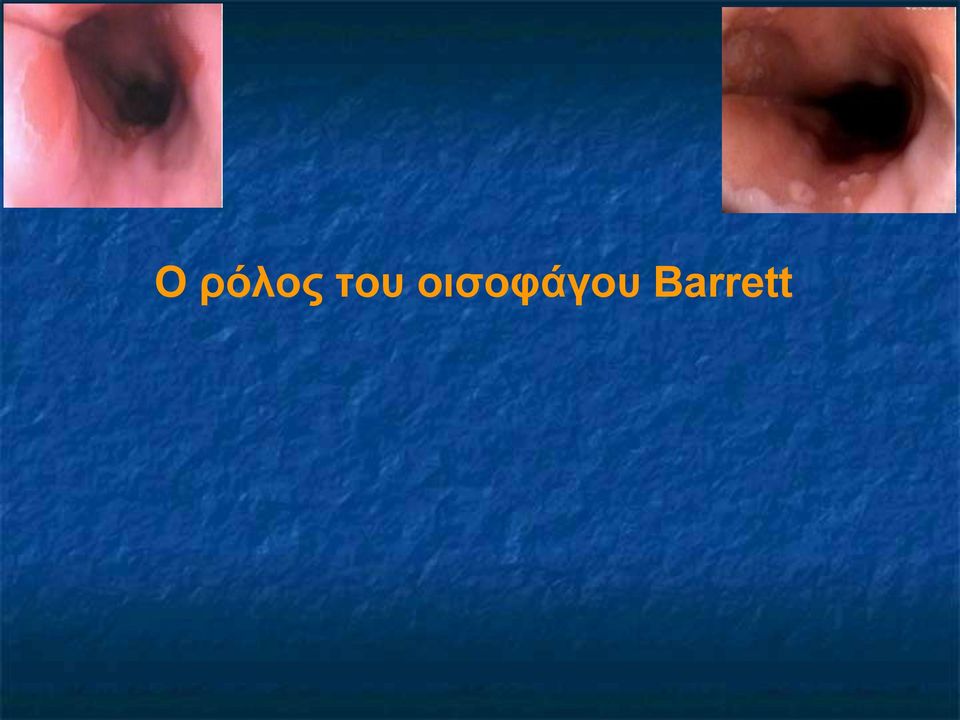 οισοφάγου