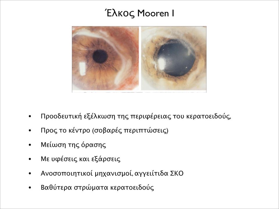 Μείωση της όρασης Με υφέσεις και εξάρσεις