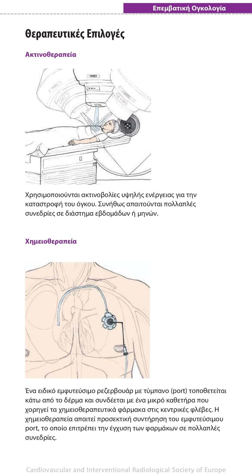 Χημειοθεραπεία Ένα ειδικό εμφυτεύσιμο ρεζερβουάρ με τύμπανο (port) τοποθετείται κάτω από το δέρμα και συνδέεται με ένα μικρό καθετήρα που χορηγεί τα