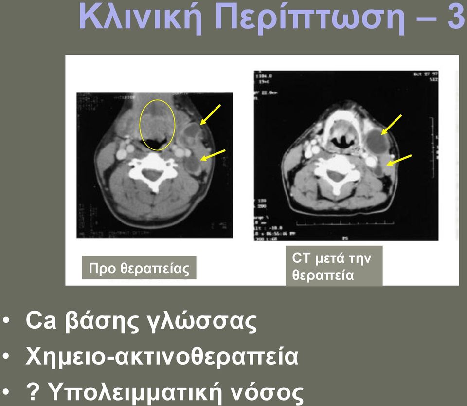 θεραπεία Ca βάσης γλώσσας