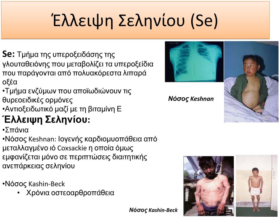 Έλλειψη Σεληνίου: Σπάνια Νόσος Keshnan: Ιογενής καρδιομυοπάθεια από μεταλλαγμένο ιό Coxsackie η οποίαόμως εμφανίζεται