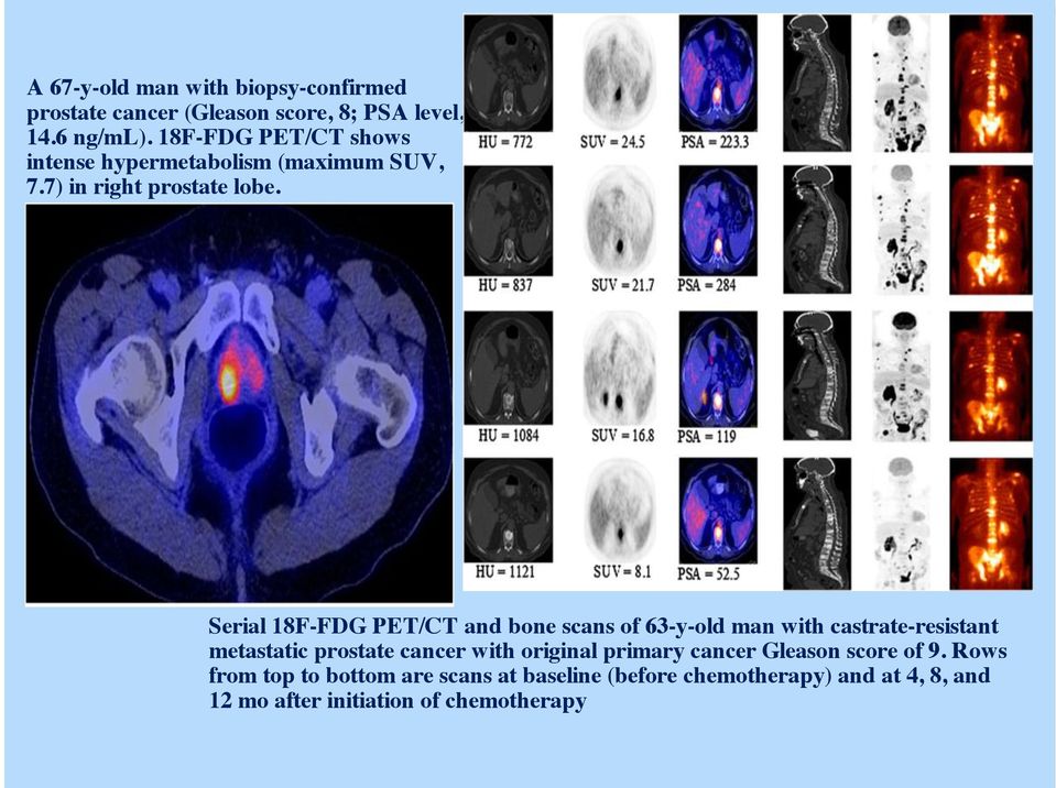 Serial 18F-FDG PET/CT and bone scans of 63-y-old man with castrate-resistant metastatic prostate cancer with