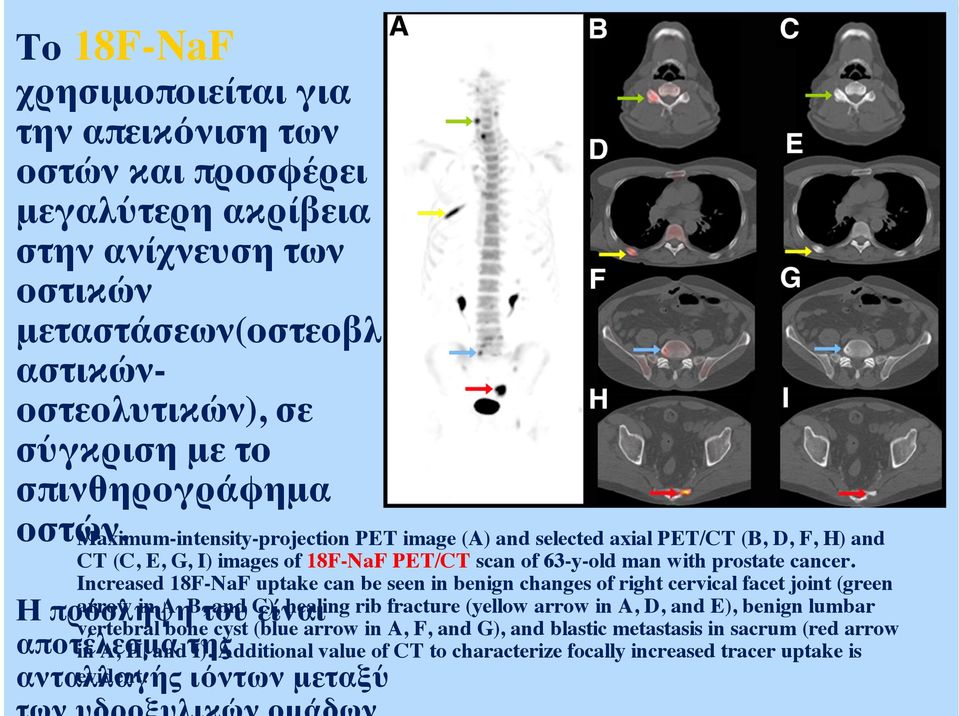 Increased 18F-NaF uptake can be seen in benign changes of right cervical facet joint (green arrow in A, B, and C), healing rib fracture (yellow arrow in A, D, and E), benign lumbar Η πρόσληψη του