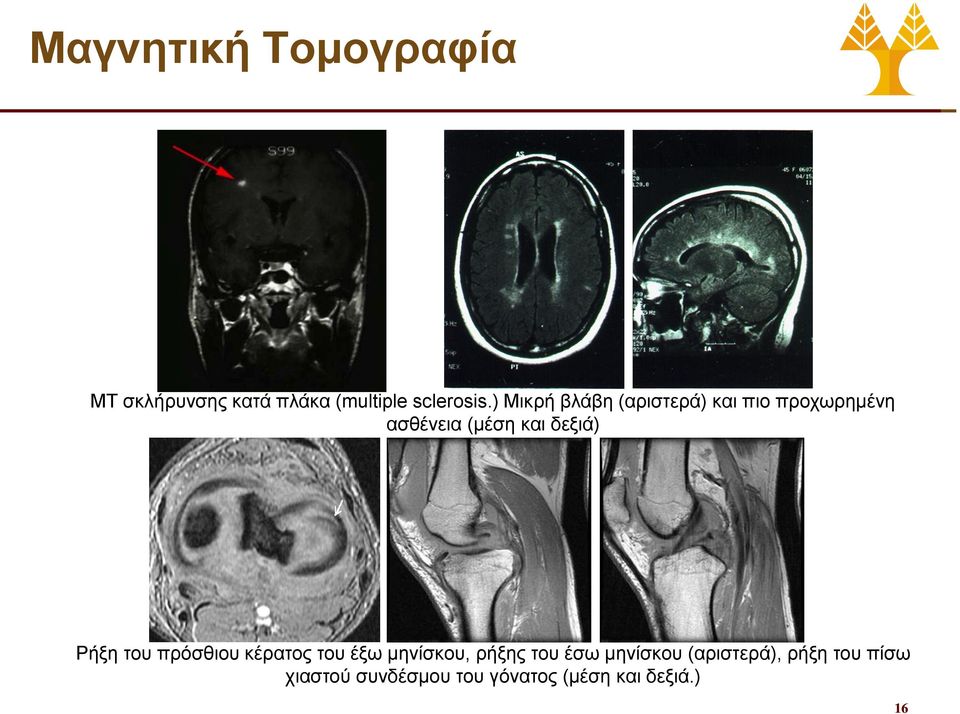 δεξιά) Ρήξη του πρόσθιου κέρατος του έξω μηνίσκου, ρήξης του έσω