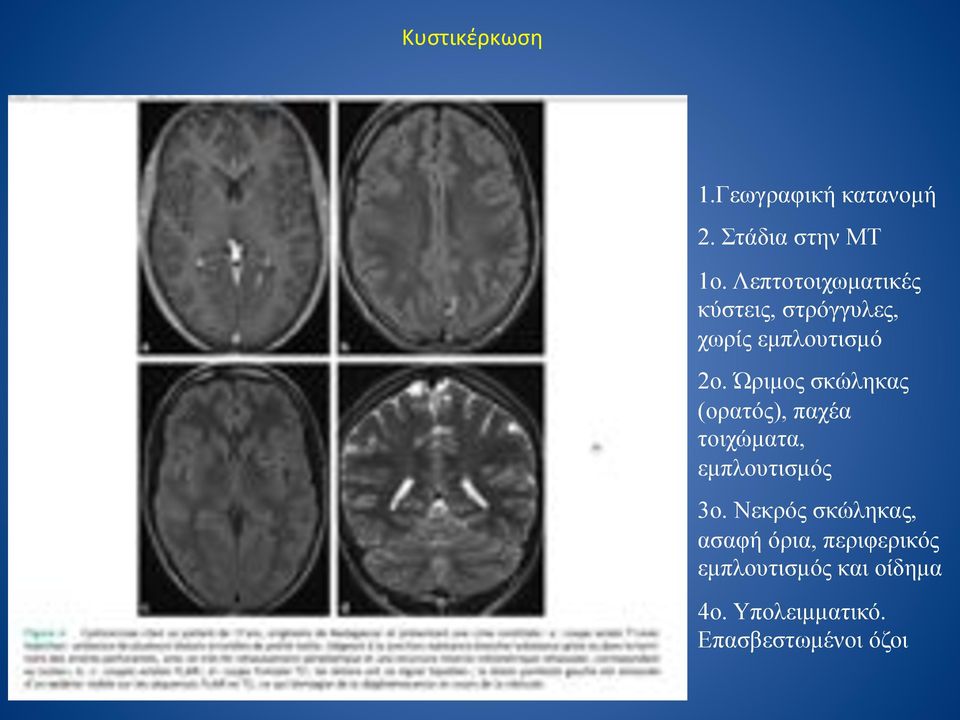 Ώριµος σκώληκας (ορατός), παχέα τοιχώµατα, εµπλουτισµός 3ο.
