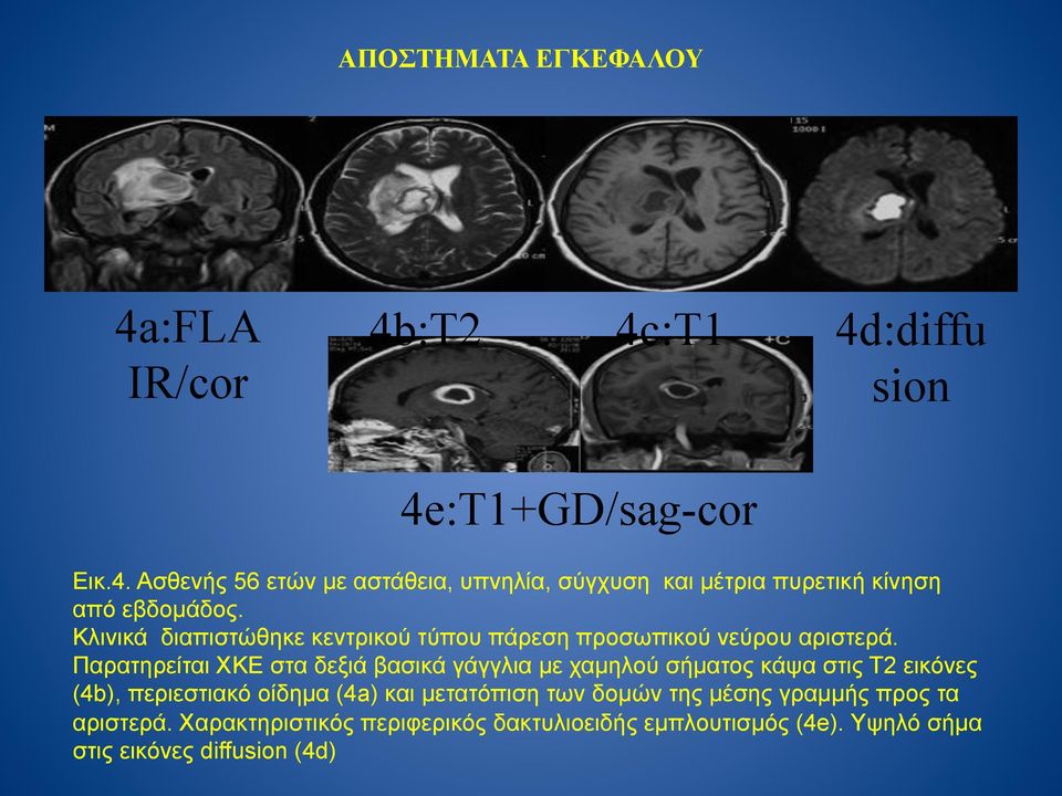 Παρατηρείται ΧΚΕ στα δεξιά βασικά γάγγλια µε χαµηλού σήµατος κάψα στις Τ2 εικόνες (4b), περιεστιακό οίδηµα (4a) και µετατόπιση