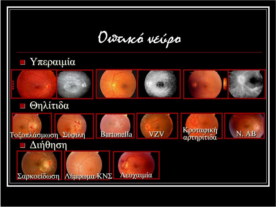 Bartonella VZV Κροταφική