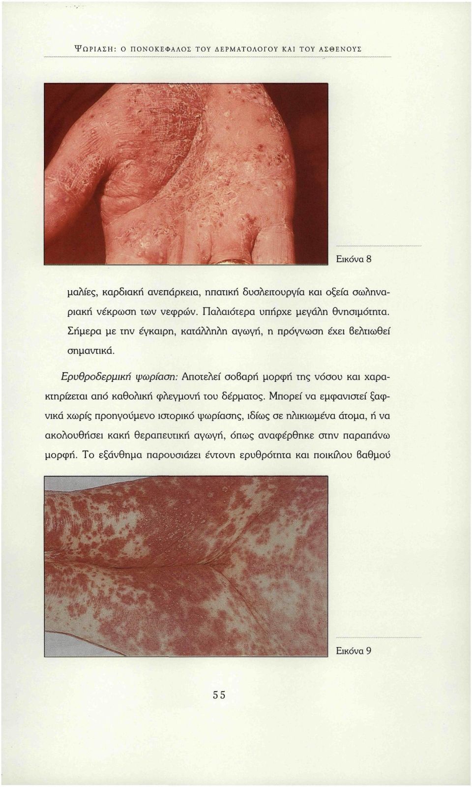 Ερυθροδερμική ψωρίαση: Αποτελεί σοβαρή μορφή της νόσου και χαρακτηρίζεται από καθολική φλεγμονή του δέρματος.