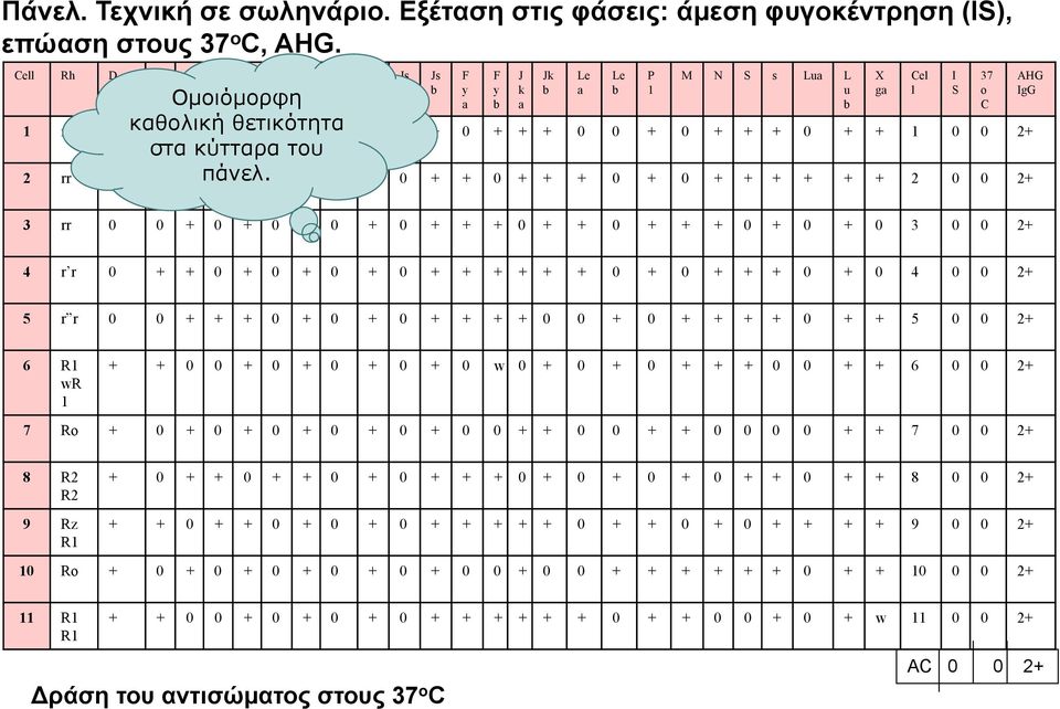 AHG IgG 3 rr 0 0 + 0 + 0 + 0 + 0 + + + 0 + + 0 + + + 0 + 0 + 0 3 0 0 2+ 4 r r 0 + + 0 + 0 + 0 + 0 + + + + + + 0 + 0 + + + 0 + 0 4 0 0 2+ 5 r r 0 0 + + + 0 + 0 + 0 + + + + 0 0 + 0 + + + + 0 + + 5 0 0