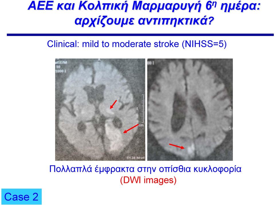 Clinical: mild to moderate stroke