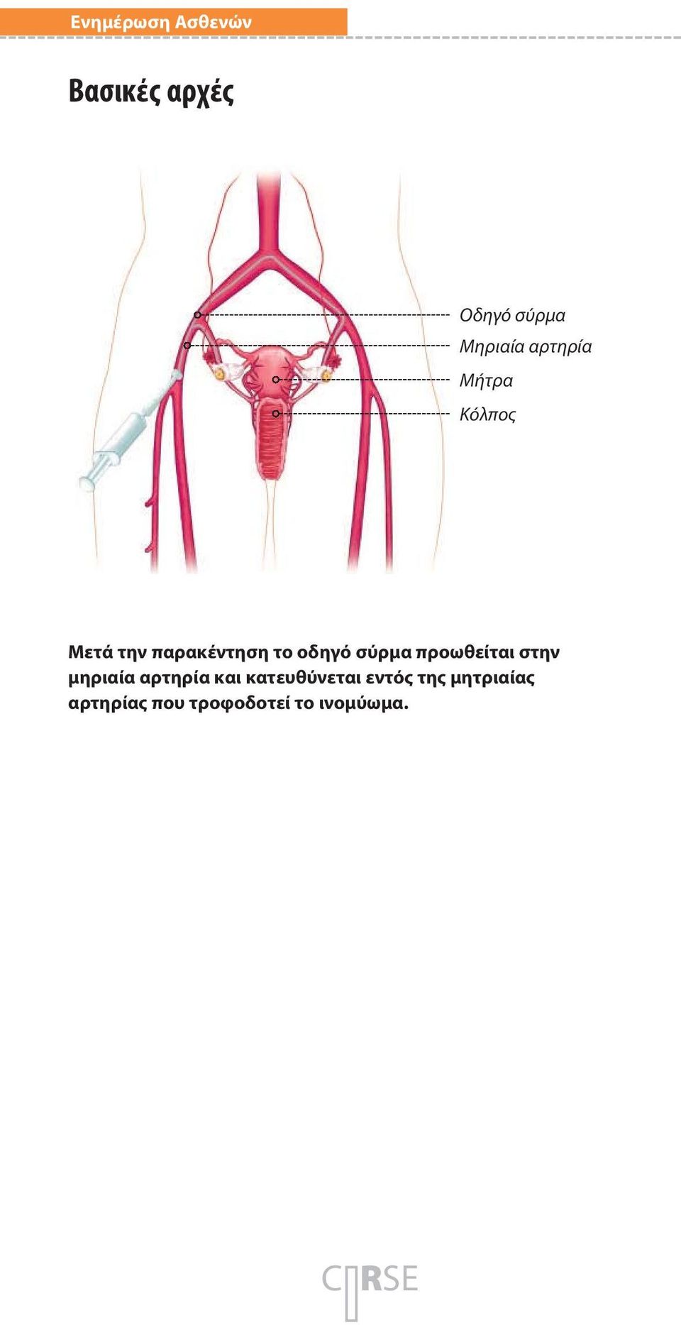 σύρμα προωθείται στην μηριαία αρτηρία και