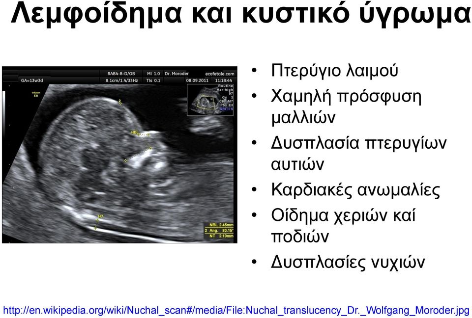 χεριών καί ποδιών Δυσπλασίες νυχιών http://en.wikipedia.