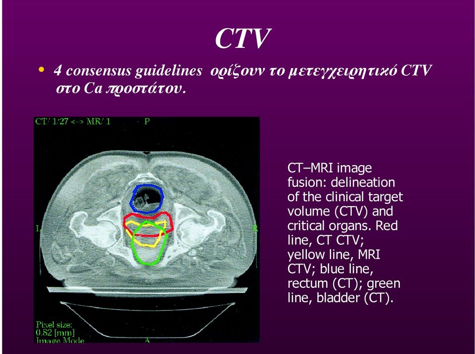 CT MRI image fusio: delieatio of the cliical target volume