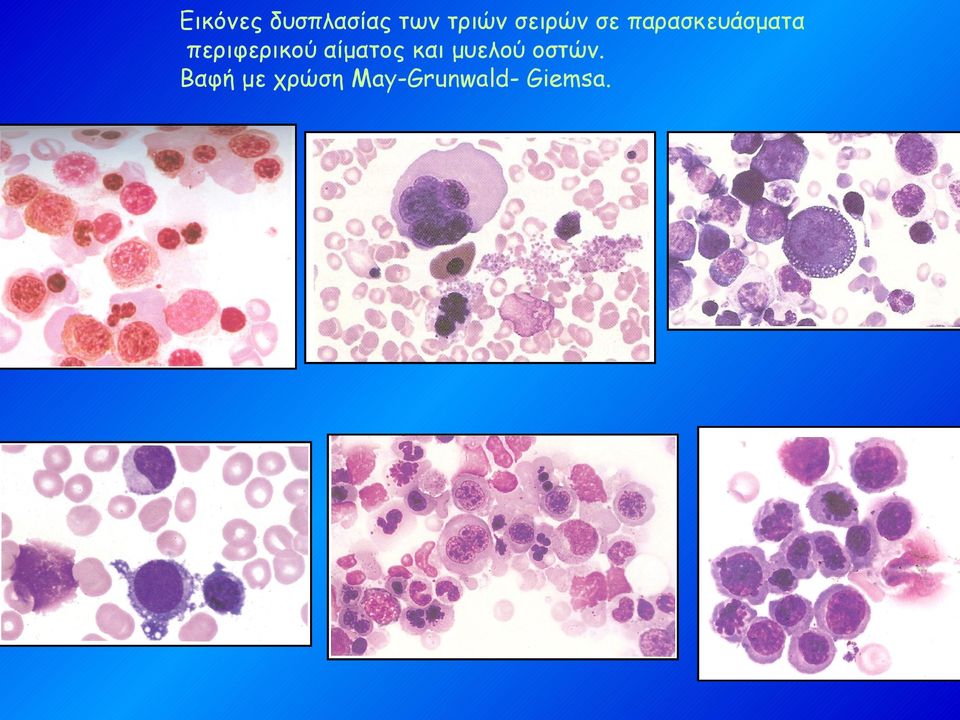 περιφερικού αίματος και μυελού