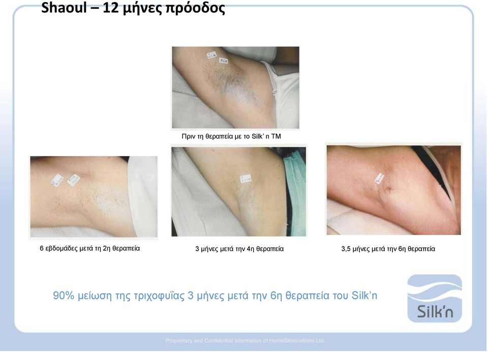 6η θεραπεία 90% μείωση της τριχοφυΐας 3 μήνες μετά την 6η θεραπεία