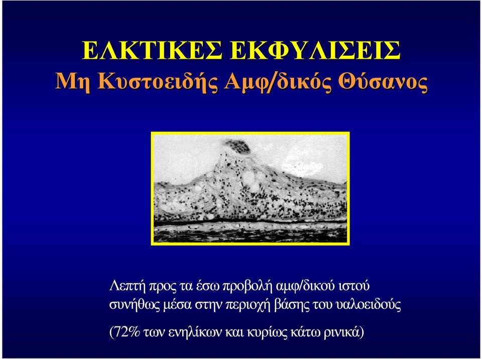 προβολή αµφ/δικού ιστού συνήθως µέσα στην περιοχή