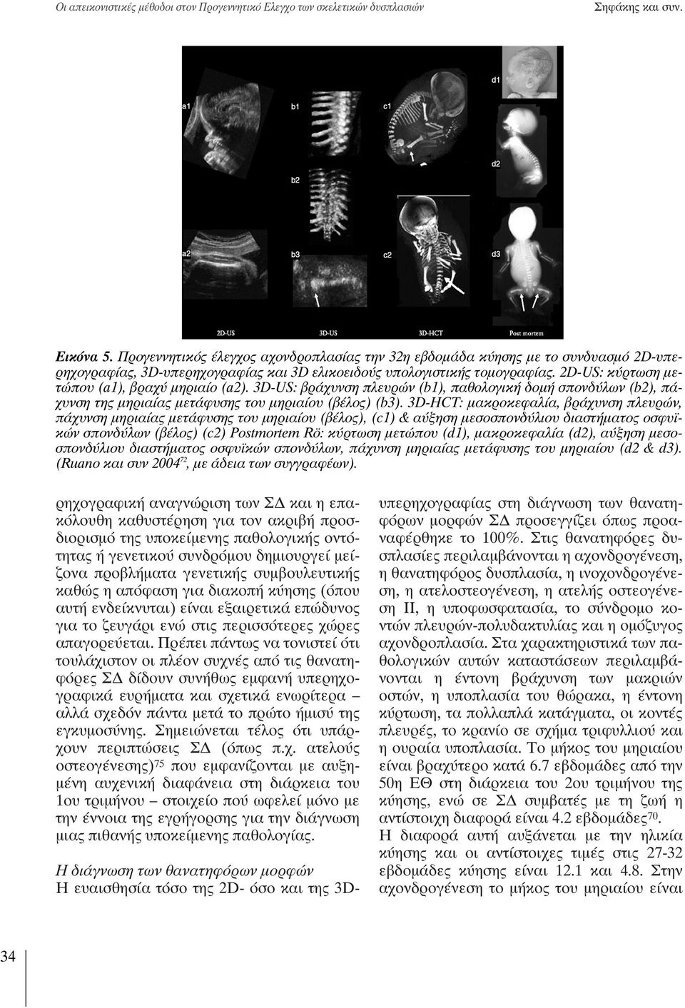 2D-US: κύρτωση μετώπου (a1), βραχύ μηριαίο (a2). 3D-US: βράχυνση πλευρών (b1), παθολογική δομή σπονδύλων (b2), πάχυνση της μηριαίας μετάφυσης του μηριαίου (βέλος) (b3).