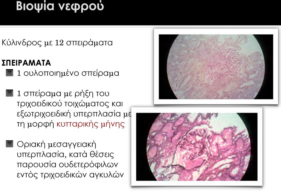 εξωτριχοειδική υπερπλασία µε τη µορφή κυτταρικής µήνης Οριακή