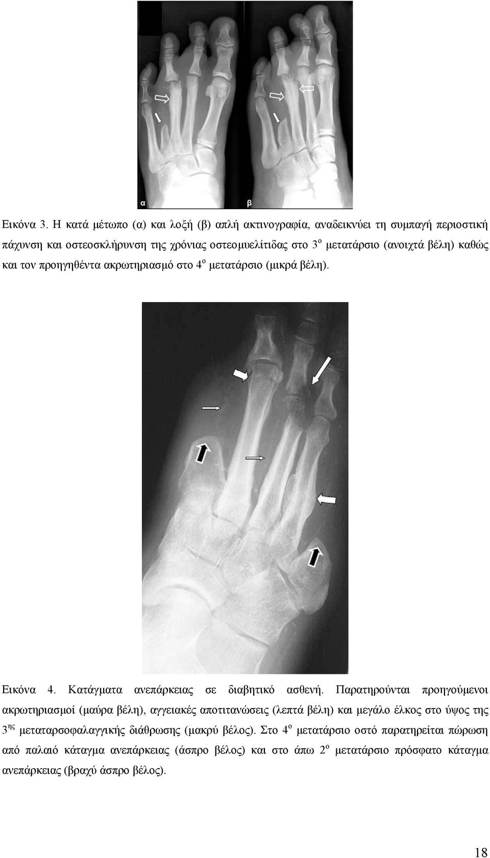 (ανοιχτά βέλη) καθώς και τον προηγηθέντα ακρωτηριασµό στο 4 ο µετατάρσιο (µικρά βέλη). Εικόνα 4. Κατάγµατα ανεπάρκειας σε διαβητικό ασθενή.