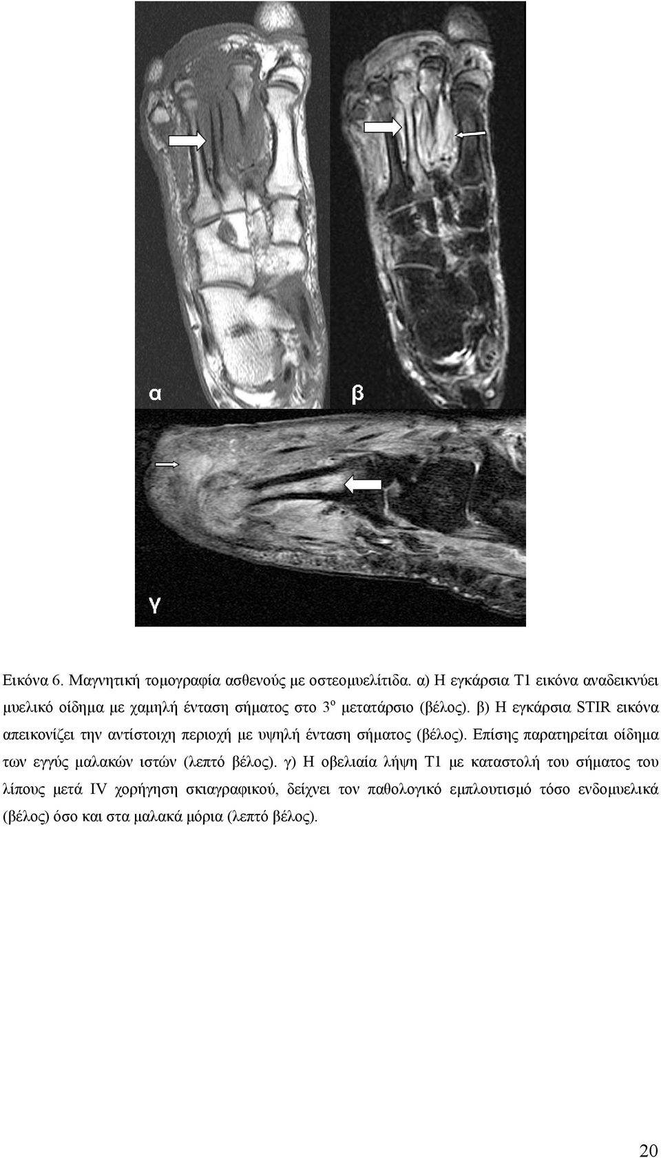 β) Η εγκάρσια STIR εικόνα απεικονίζει την αντίστοιχη περιοχή µε υψηλή ένταση σήµατος (βέλος).