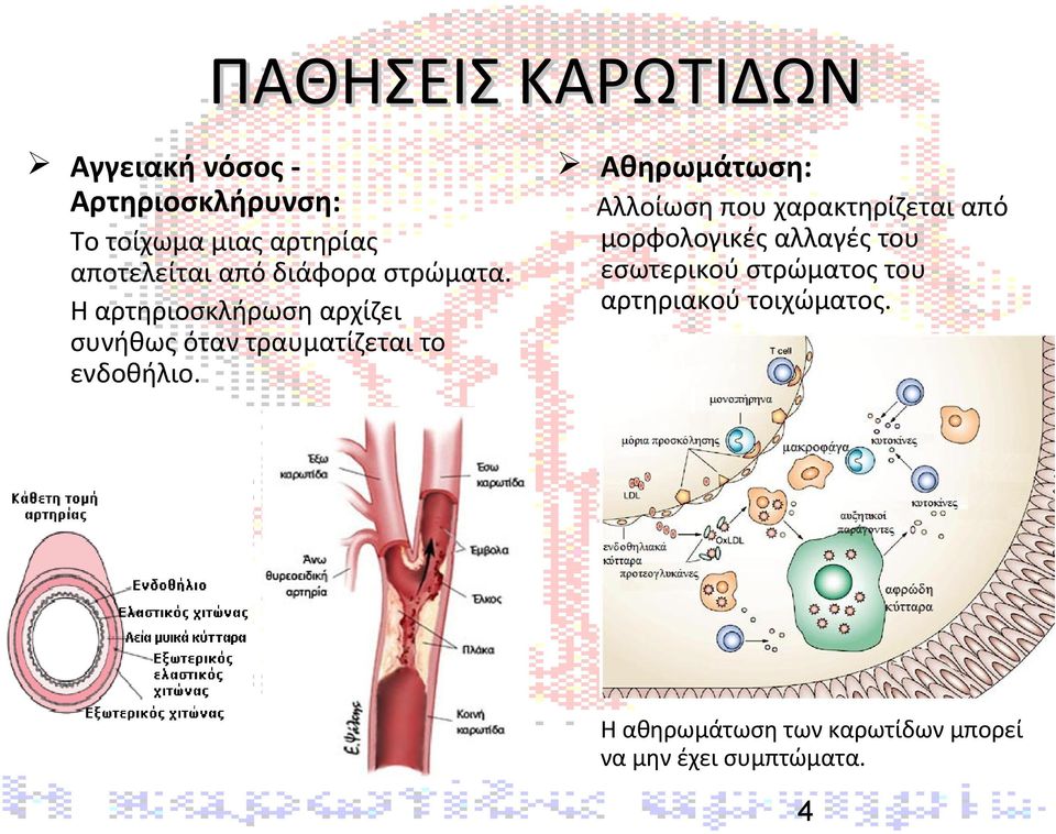 Η αρτηριοσκλήρωση αρχίζει συνήθως όταν τραυματίζεται το ενδοθήλιο.