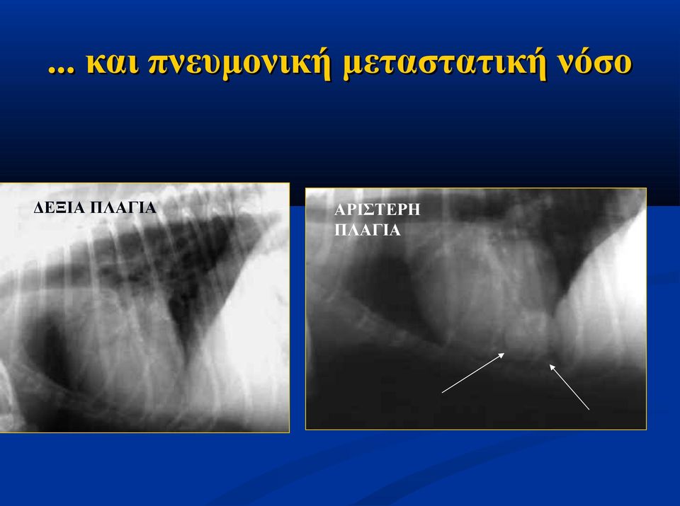 μεταστατική