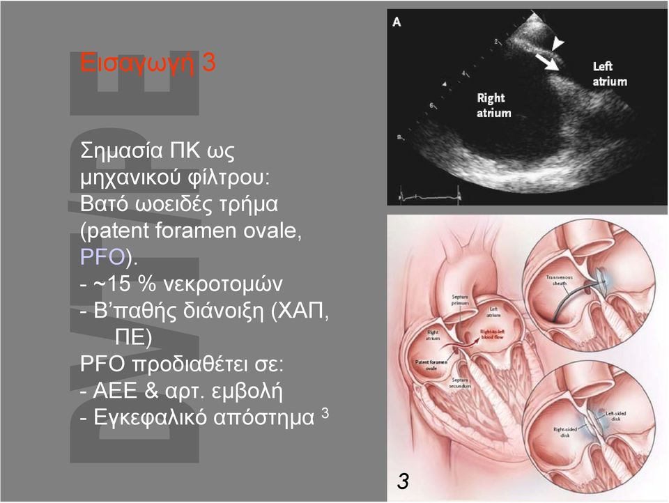 -~15 % νεκροτομών - Β παθής διάνοιξη (ΧΑΠ, ΠΕ) PFO