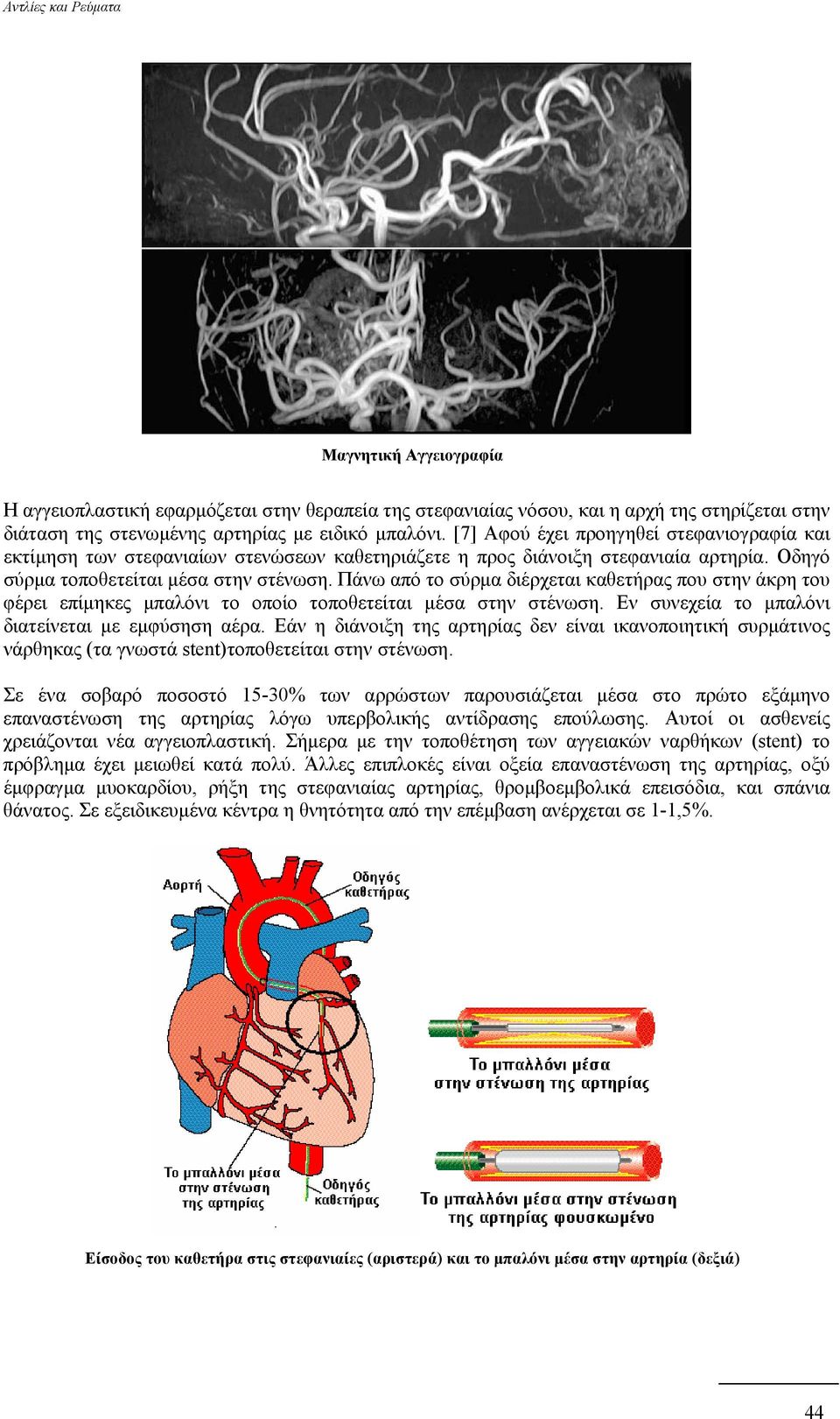 Πάνω από το σύρµα διέρχεται καθετήρας που στην άκρη του φέρει επίµηκες µπαλόνι το οποίο τοποθετείται µέσα στην στένωση. Εν συνεχεία το µπαλόνι διατείνεται µε εµφύσηση αέρα.