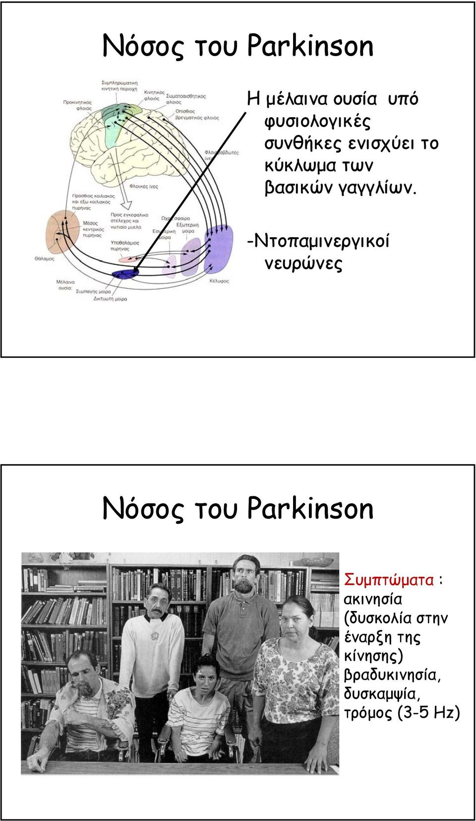 -Ντοπαµινεργικοί νευρώνες Νόσος του Parkinson Συµπτώµατα :