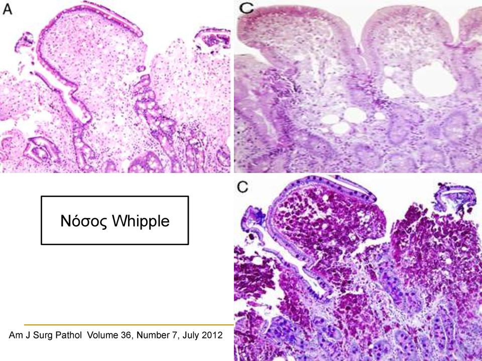 Surg Pathol