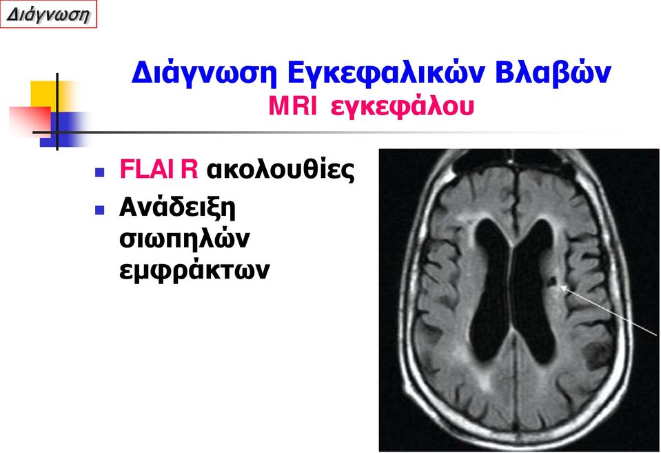 εγκεφάλου FLAIR