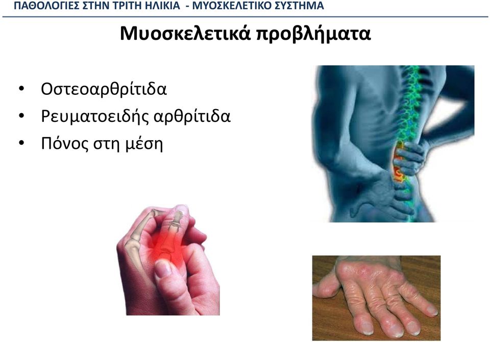 Οστεοαρθρίτιδα