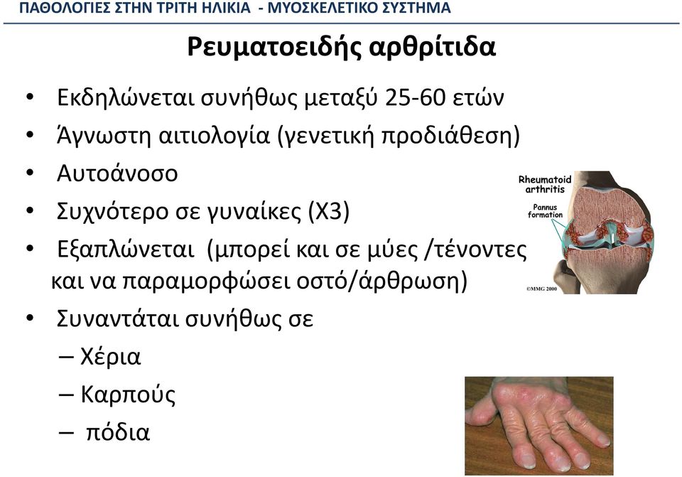 γυναίκες (Χ3) Εξαπλώνεται (μπορεί και σε μύες /τένοντες και να