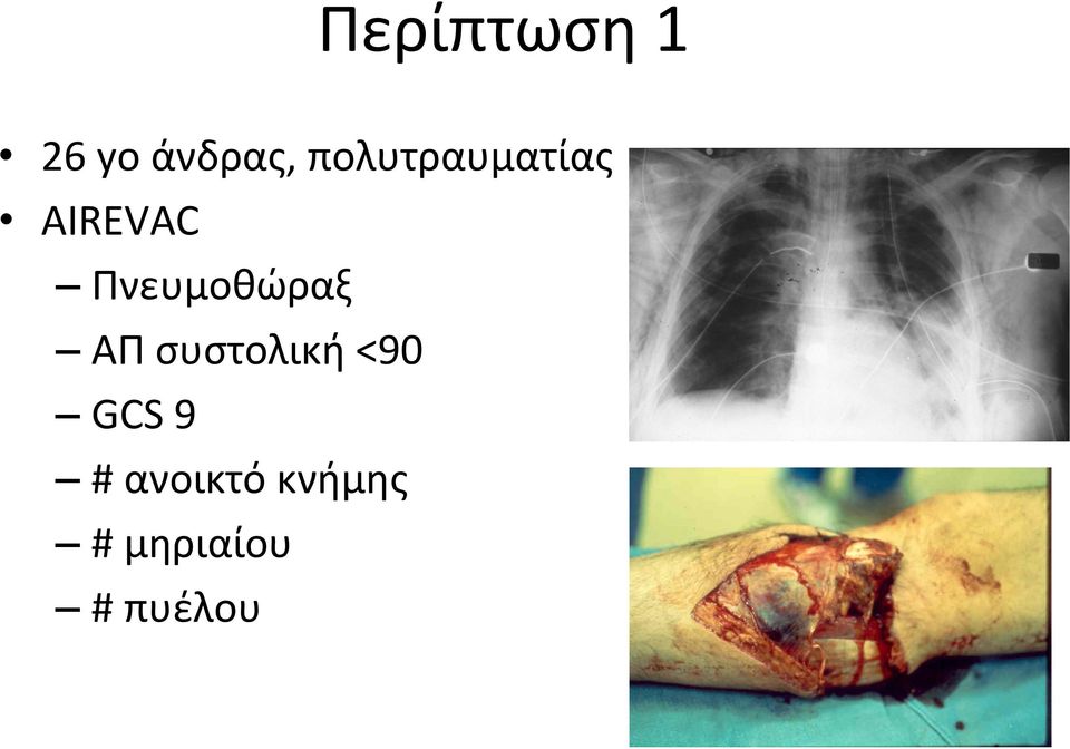 Πνευμοθώραξ ΑΠ συστολική <90