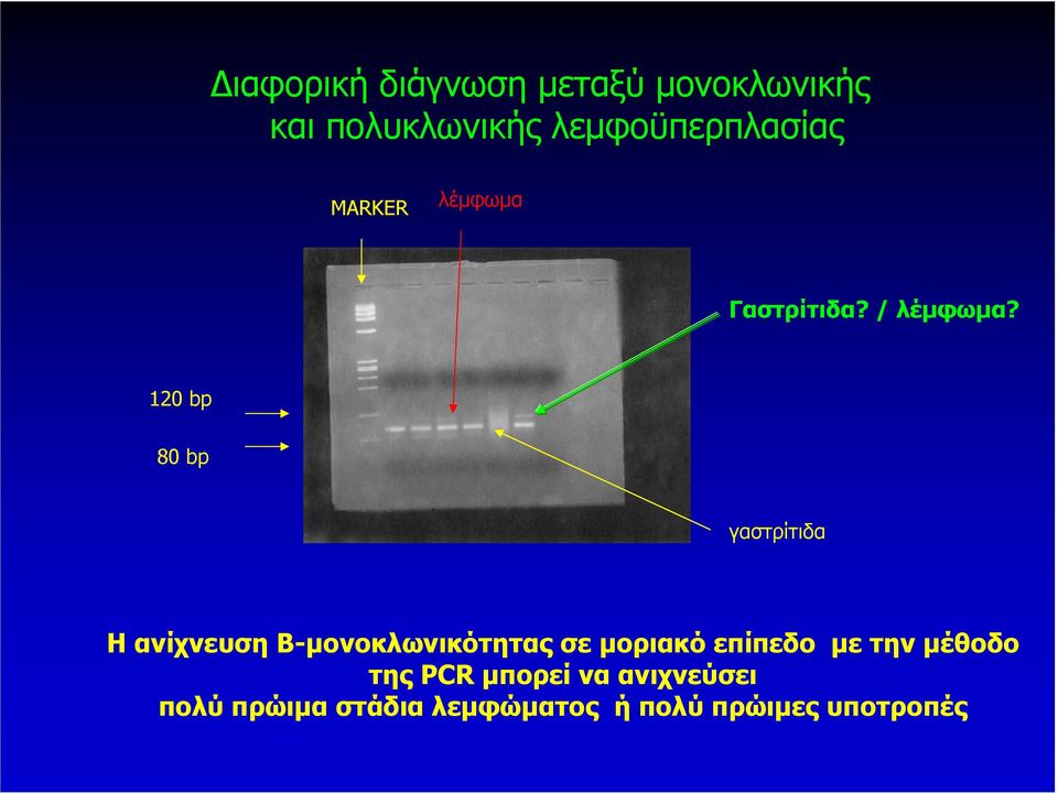 120 bp 80 bp γαστρίτιδα Η ανίχνευση Β-µονοκλωνικότητας σε µοριακό