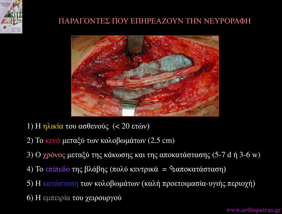 5 cm) 3) Ο χρόνος μεταξύ της κάκωσης και της αποκατάστασης (5-7 d ή 3-6 w) 4) Το