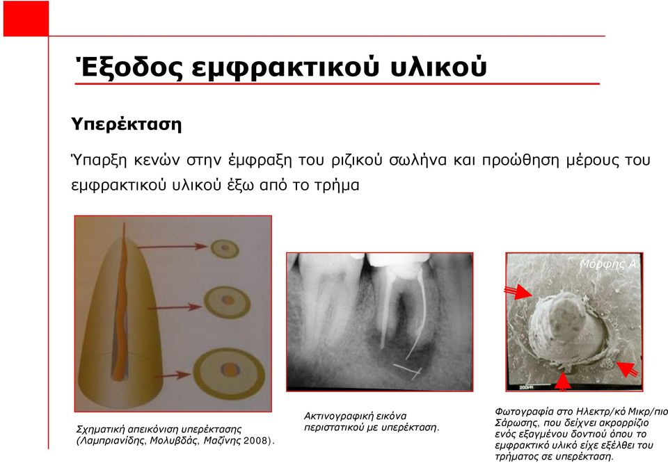 Σχηματική απεικόνιση υπερέκτασης (Λαμπριανίδης, Μολυβδάς, Μαζίνης 2008).