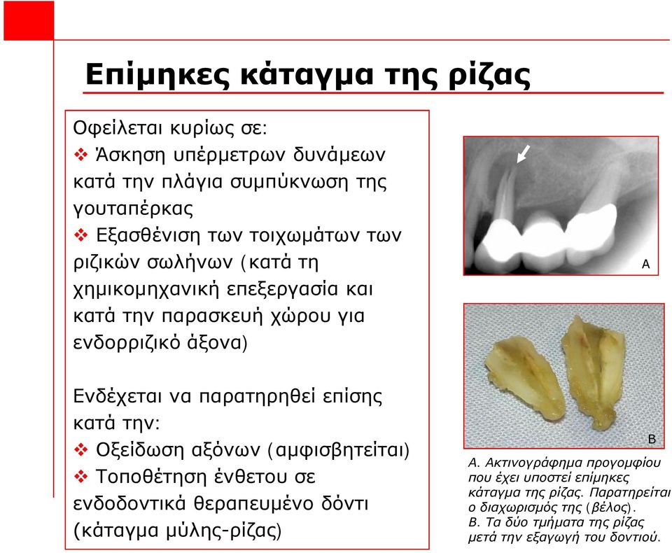 επίσης κατά την: v Οξείδωση αξόνων (αμφισβητείται) v Τοποθέτηση ένθετου σε ενδοδοντικά θεραπευμένο δόντι (κάταγμα μύλης-ρίζας) Β Α.