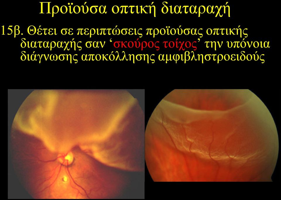 οπτικής διαταραχής σαν σκούρος τοίχος