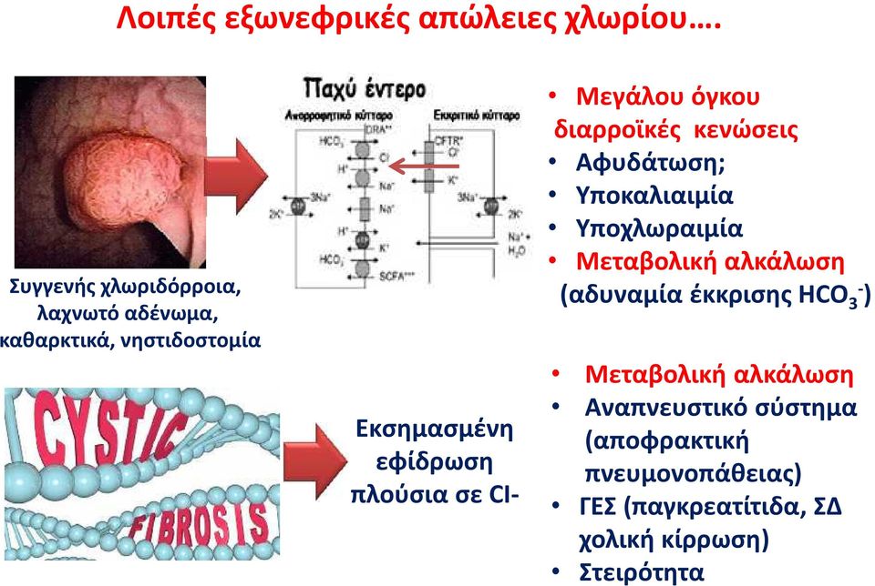 σε CI- Μεγάλου όγκου διαρροϊκές κενώσεις Αφυδάτωση; Υποκαλιαιμία Υποχλωραιμία Μεταβολική