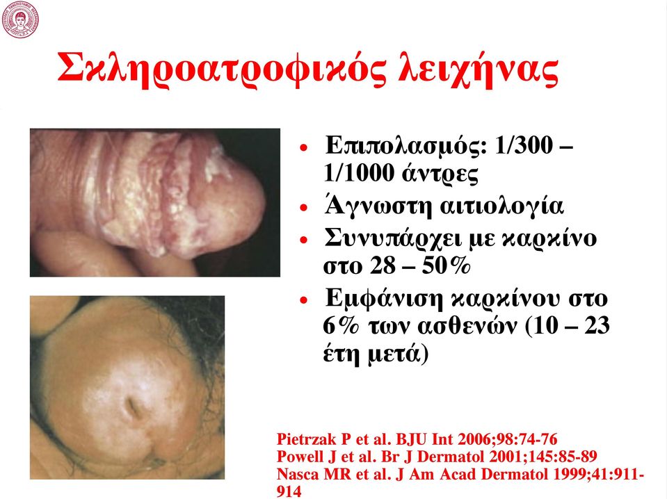 J Am Acad Dermatol 1999;41:911-914 Σκληροατροφικός λειχήνας Επιπολασμός: