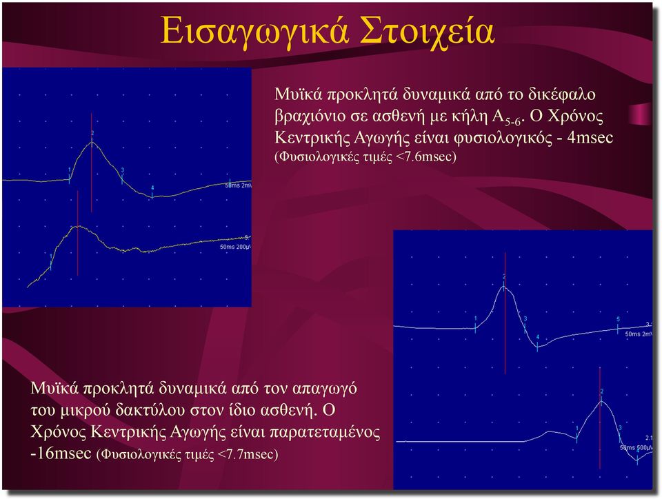 Ο Χρόνος Κεντρικής Αγωγής είναι φυσιολογικός - 4msec (Φυσιολογικές τιµές <7.