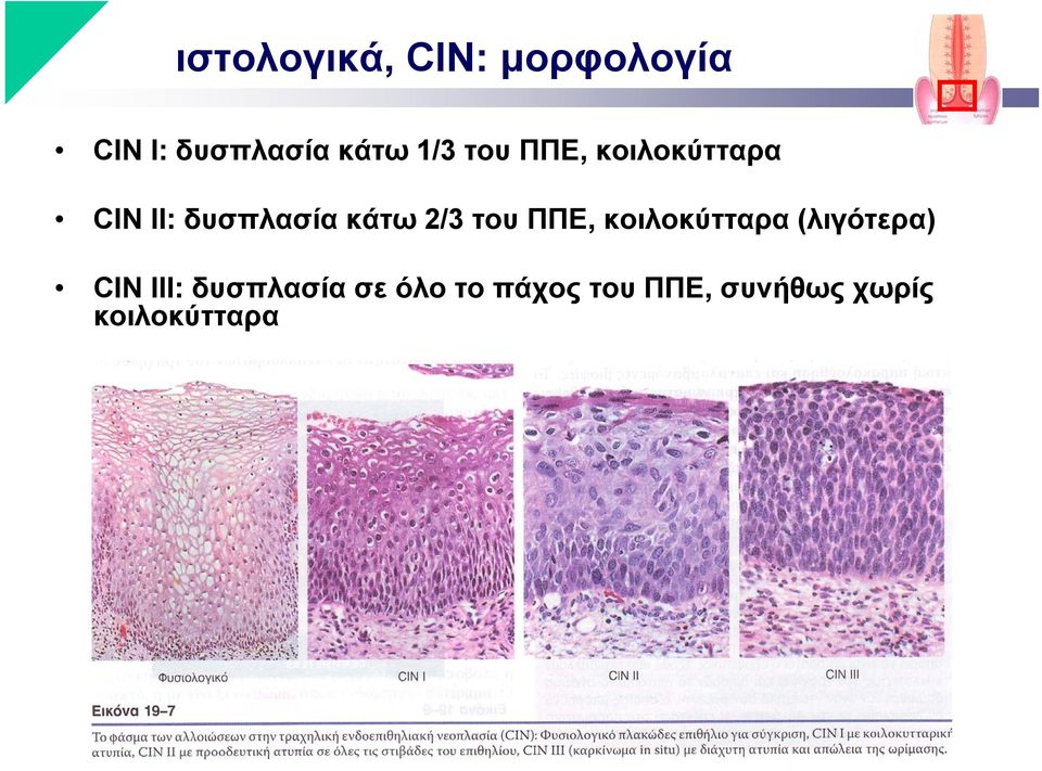2/3 του ΠΠΕ, κοιλοκύτταρα (λιγότερα) CIN III: