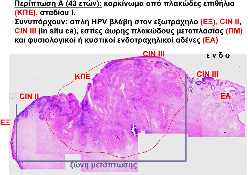 ca), εστίες άωρης πλακώδους μεταπλασίας (ΠΜ) και φυσιολογικοί ή κυστικοί