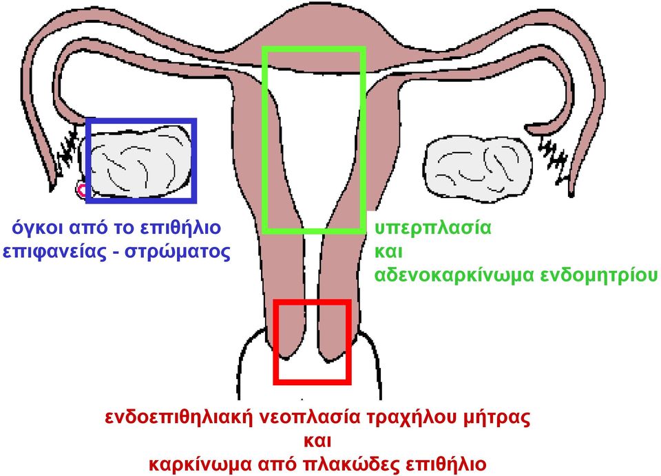 ενδομητρίου ενδοεπιθηλιακή νεοπλασία